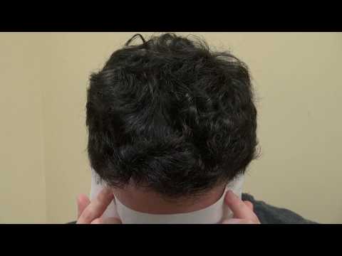 FUE Hair Transplant
