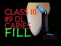 Class III Composite #9 DL FIll