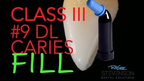 Class III Composite Restoration #9 DL FIll