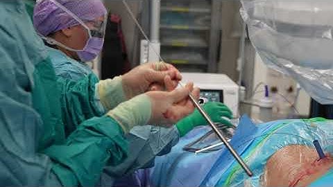 PCNL Live case using Alkan metal dilators