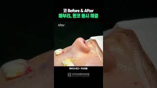 [수술전후] 매부리+휜코 동시에 해결 | 디아이성형외과 #매부리코교정 #휜코수술 #디아이성형외과