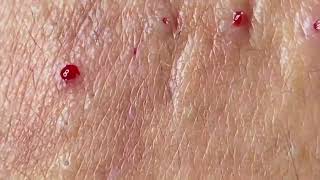 new pimple popping videos blackheads 2023 3