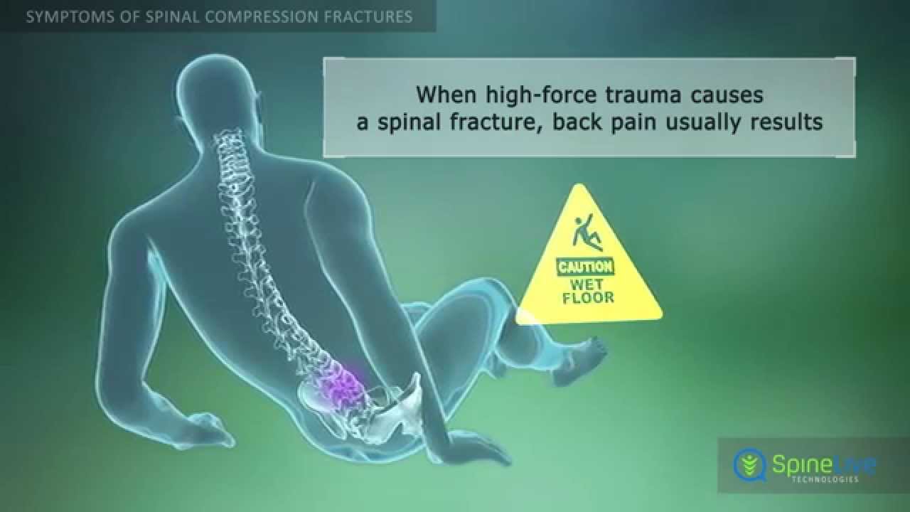 Spinal Compression Fractures Symptoms - YouTube