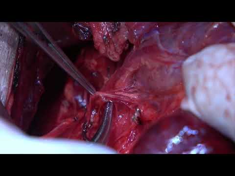 Thyroidectomy for massive goiter