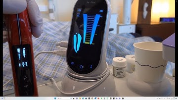 Obturating the canal with I-MTA using the 812MT and the new MTA carrier/I-MTAの根管充填　812MT とキャリアーを使用