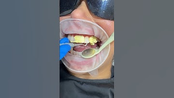 Composite bonding short video #shorts #composite #dentist