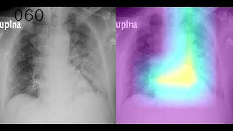 XAI : Occlusion with decreasing patch size on Covid-19 X-ray image