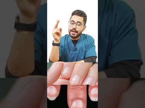 لو أظافرك بيضاء تعرف علي السبب