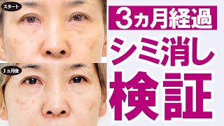 【シミが消えるか！3カ月検証】3カ月目の報告～