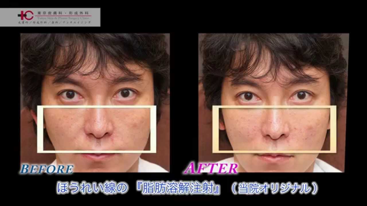 ほうれい線のイリュージョン注射 東京皮膚科 形成外科 Youtube ほうれい線のイリュージョン注射 東京皮膚科 形成外科 Youtube