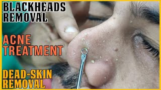 BlackHeads Removal and  Acne Treatment with Face Steam by SHAMBOO?asmr