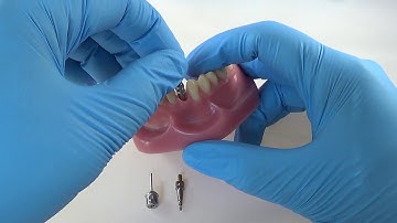 Straumann® Open Tray Impression Coping Technique