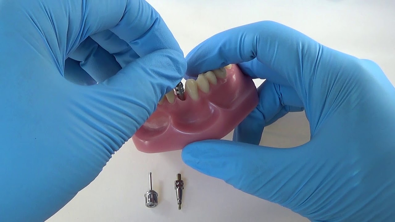 Straumann Open Tray Impression Coping Technique YouTube