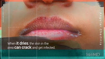 Angular cheilitis Causes, symptoms, treatment and more | “The Fastest Way to Cure Angular Cheilitis”
