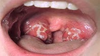 How to Treat Herpes - YouTube