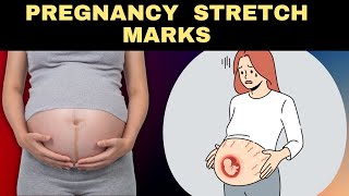 Pregnancy Stretch Marks: Causes, Treatment and Prevention | Stretch Marks