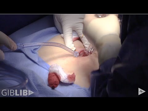 Video: Chirurgia Chistului Pilonidal: Procedura, Recuperarea și Recurența