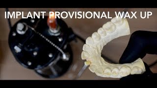 How To Wax Up Tooth!