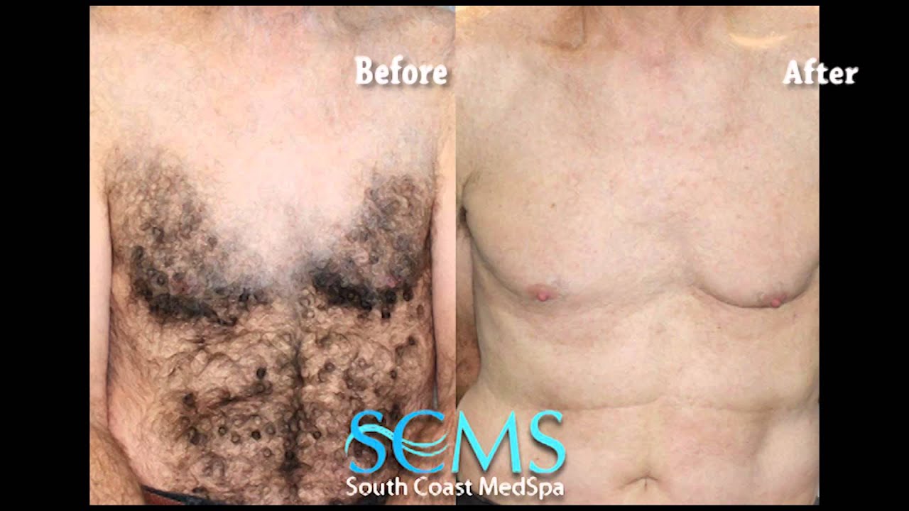 Newport Beach Laser Hair Removal Chest and Abs (Before ...