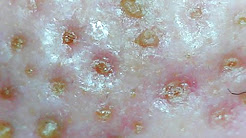 いちご鼻 角栓 とる一覧 Youtube