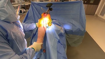 Using Lantern® Technology to achieve Kinematic Alignment in TKA