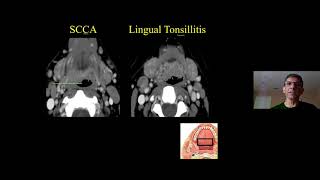 Anatomy & Pathology of the Oral Cavity & Oropharynx Dr Suresh Mukherji - MRI Online Noon Conference