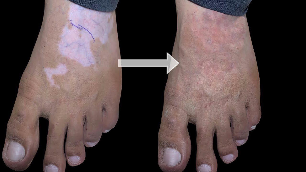 Permanent Vitiligo tattoo coverup by Machu Clinic Bangalore no