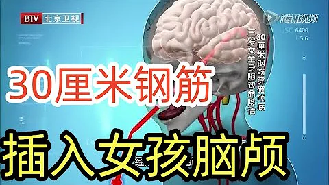 30厘米钢筋插入女孩脑颅穿过大脑竟奇迹存活！《生命缘》【北京广播电视台官方频道】 - 天天要闻