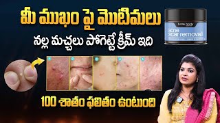 How To Remove Acne | Pimple Removal Face Pack Get Smooth and Clear Skin | ARM Pearl | iDream Women