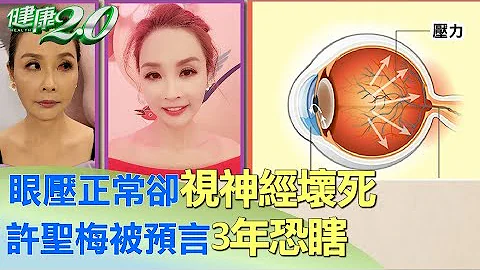 眼压正常却视神经坏死 许圣梅被预言3年恐瞎 健康2.0 - 天天要闻