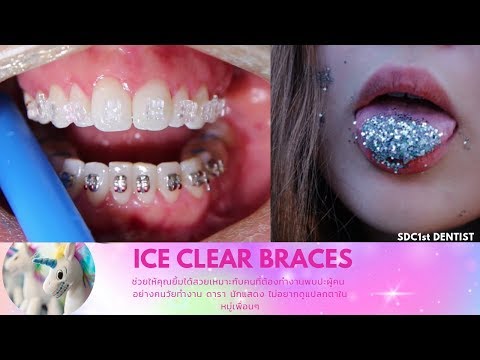 จัดฟันแบบใส จัดฟันเซรามิกใส (Ice Clear Braces) 🦄