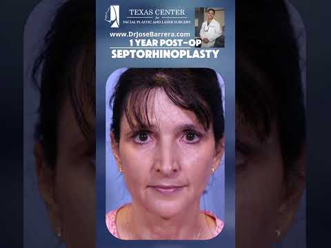 Video thumbnail: 1 Year Post-Op Results | Septorhinoplasty ✨This case highlights long-term stability. · Dr. Jose Barrera