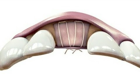 periosteal anchorage suture for Fixing the membrane  on both sides of the ridge.(Without  screw)