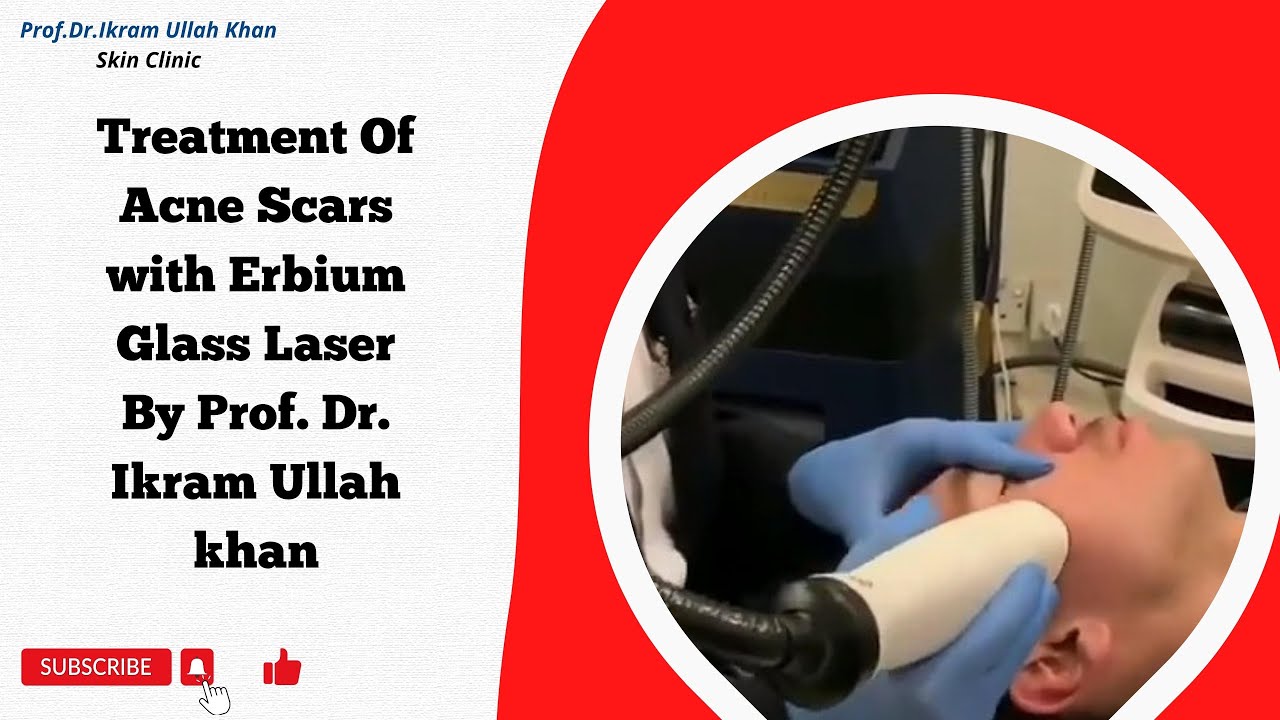Uncover Radiant Skin! Erbium Glass Laser for Acne Scar Makeover! 