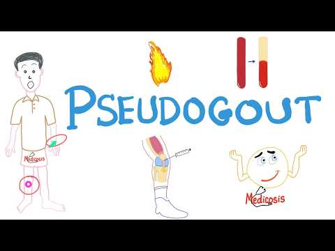 Video: Pseudogout: Dna, Příčiny, Léčba, Prevence A Další