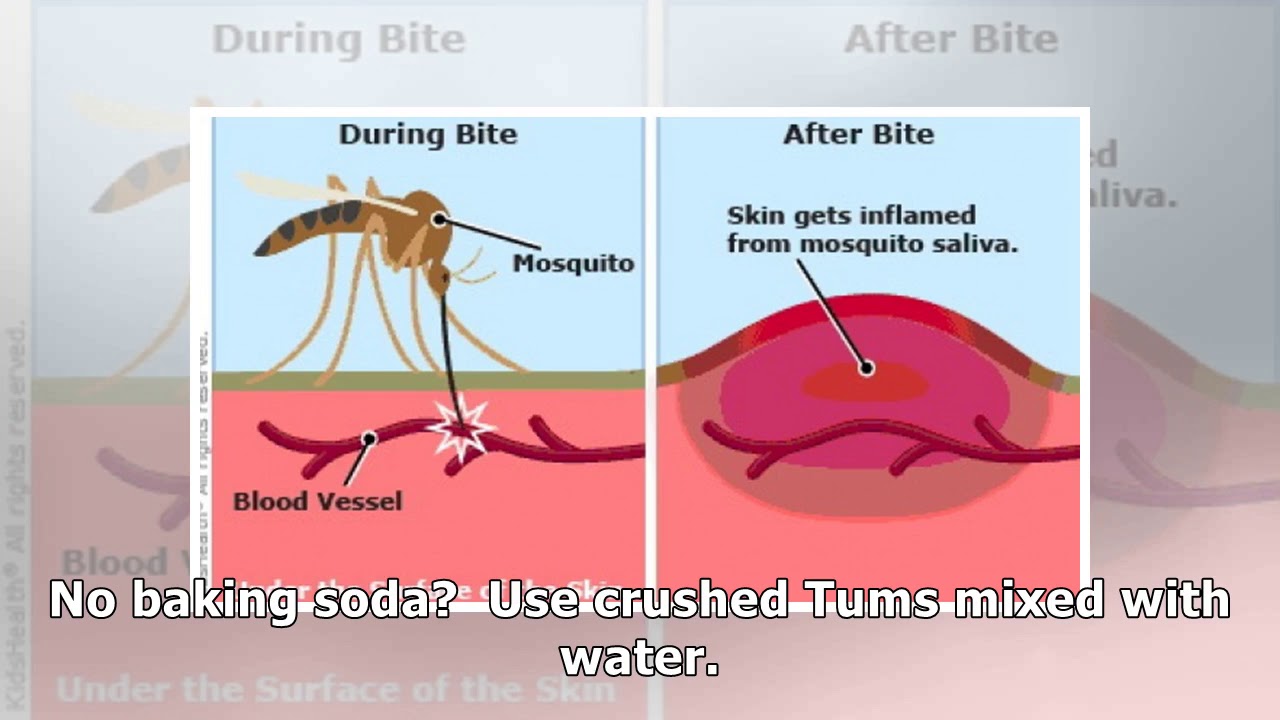 Ways to Stop Mosquito Bites From Itching - YouTube