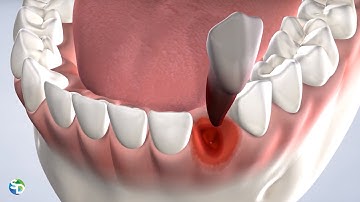 Tooth Extraction Animation | San Diego, CA |