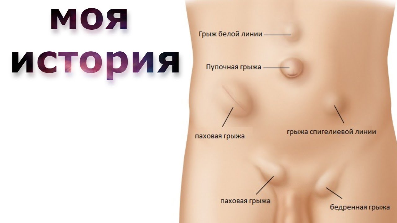 Симптомы грыжи живота у женщин слева. Грыжа спигелиевой линии. Грыжи полулунной (спигелиевой) линии. Грыжа спигелиевой линии живота.