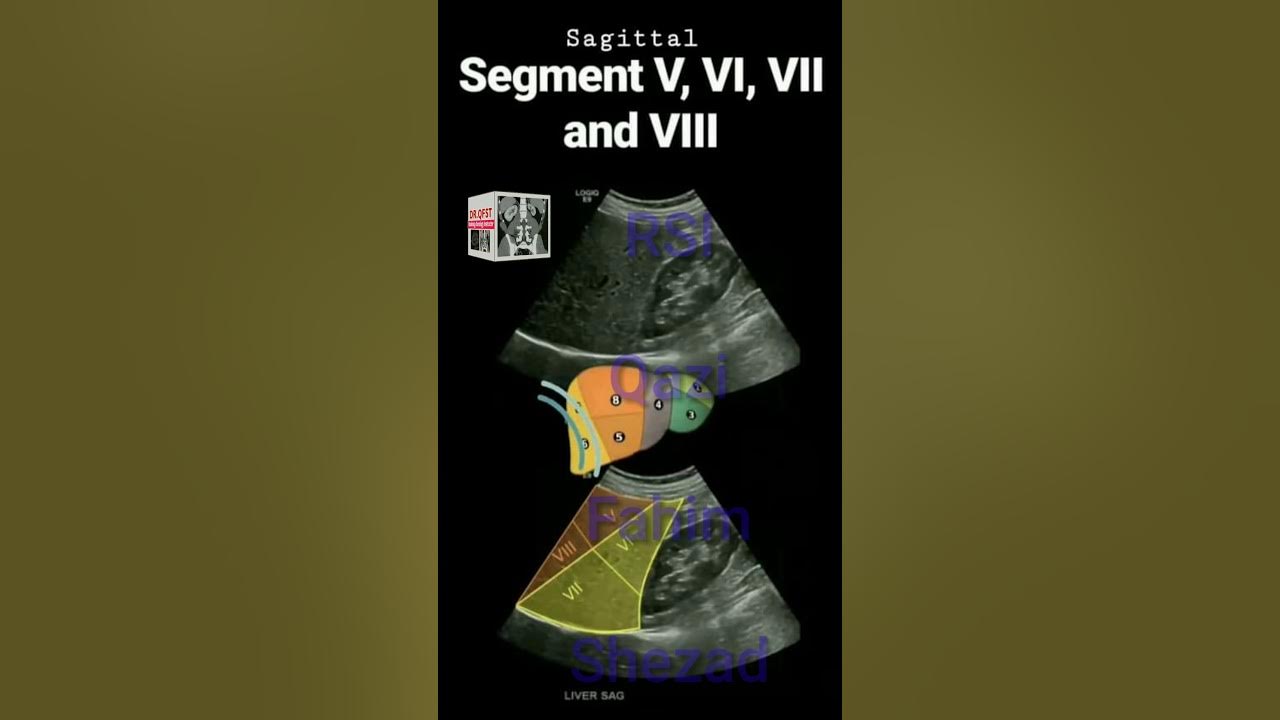Liver Segments Urdu Ultrasound YouTube liver-segments-urdu-ultrasound-youtube