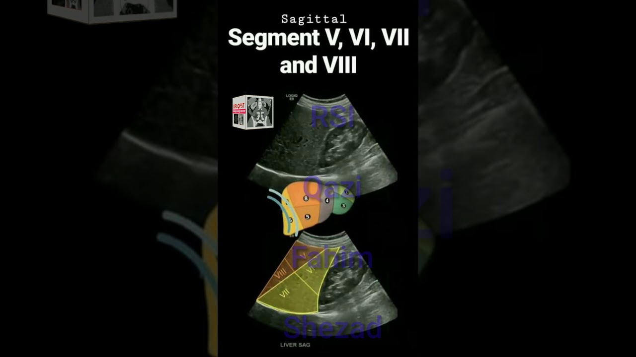 Liver Segments Urdu Ultrasound YouTube Liver Segments Urdu Ultrasound YouTube