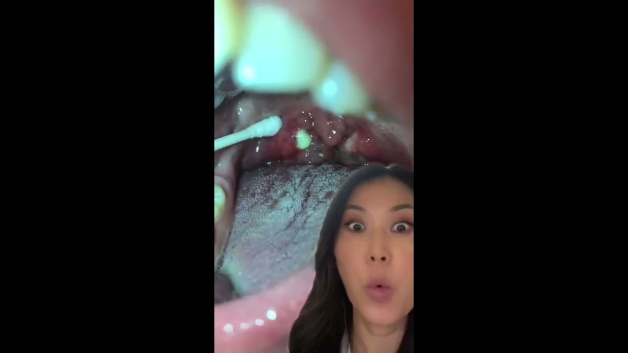 Huge Tonsil Stone Pops Right Out Tonsilstone Tonsils Dentist