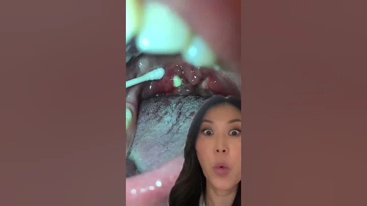 Huge tonsil stone pops right out! #tonsilstone #tonsils #dentist