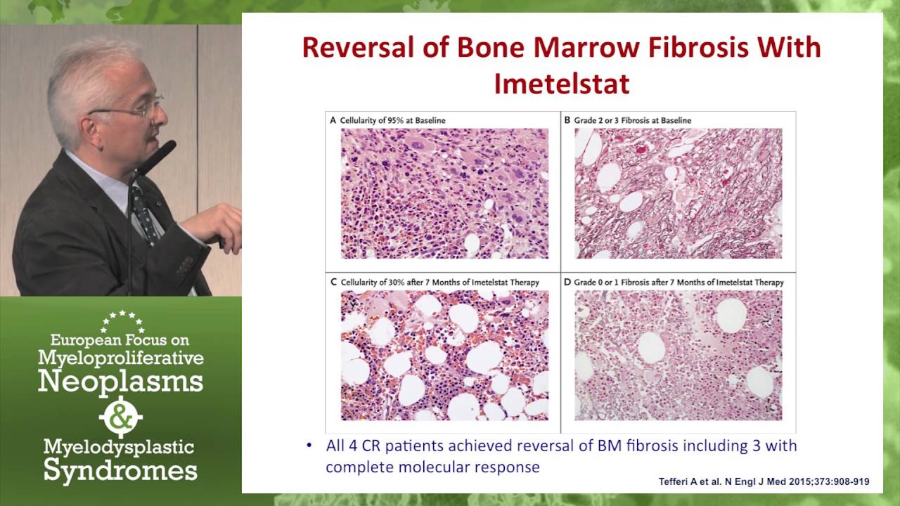Novel Agents and Combination Therapies in Myelofibrosis - YouTube