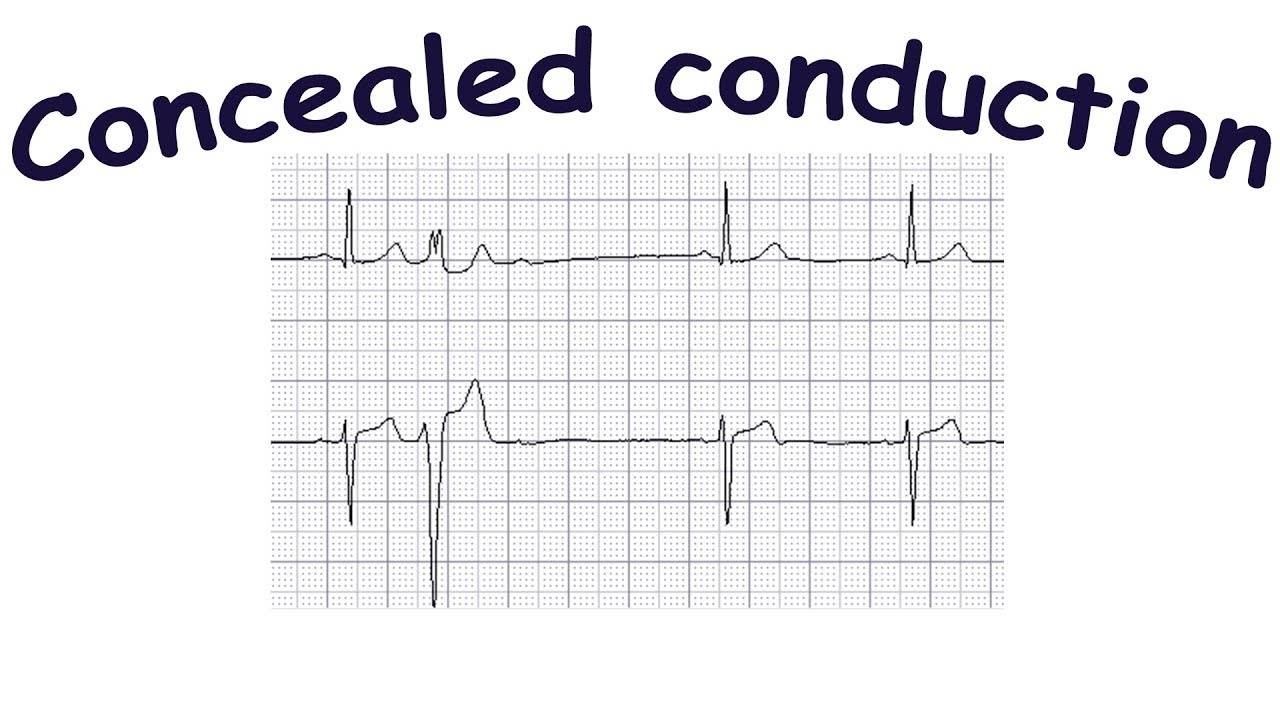 Concealed conduction -