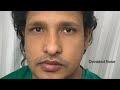 Deviated Best Nose Corrected with Septoplasty and Rhinoplasty in India