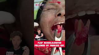 Live buccal abscessed molar tooth extraction मवाद पडे दांत को दर्द रहित निकालना #short #shorts Resimi