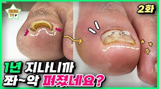 (eng sub)[2편] 1년 동안 투자한 돈이 아깝지 않아요ㅎㅎ 왕뿌듯!｜레푸스 서면점/사상점｜ingrown toenail｜Athlete&#39;s foot-Fresh Foot