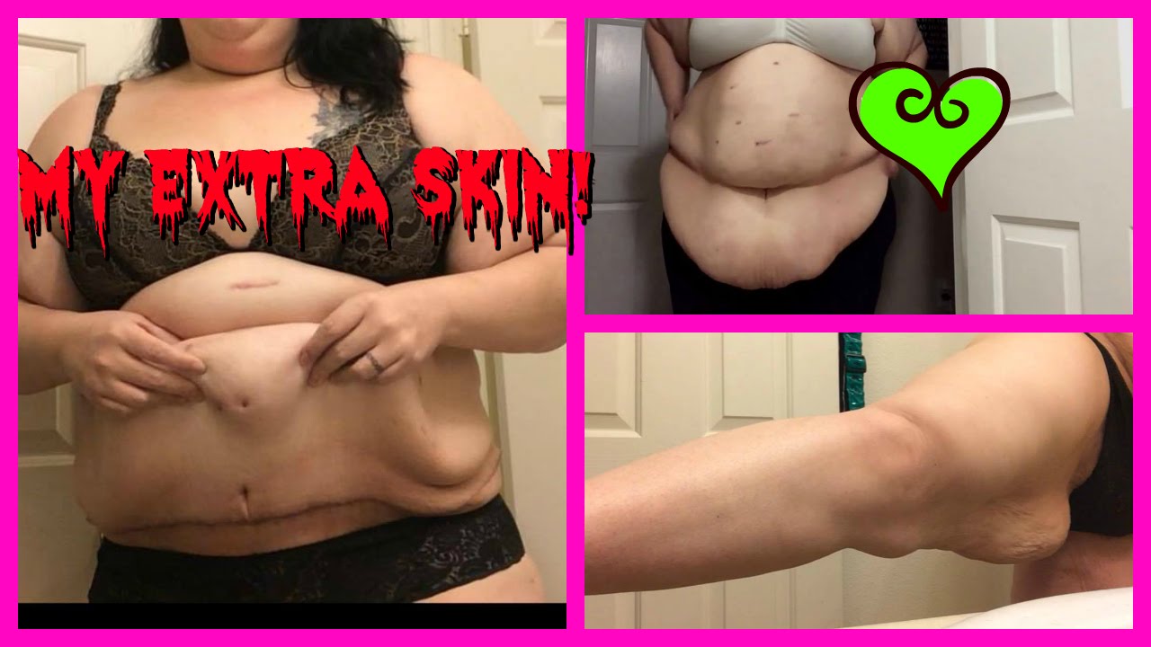 loose skin 3 months post op panniculectomy tummy tuck youtube plus size tummy tuck