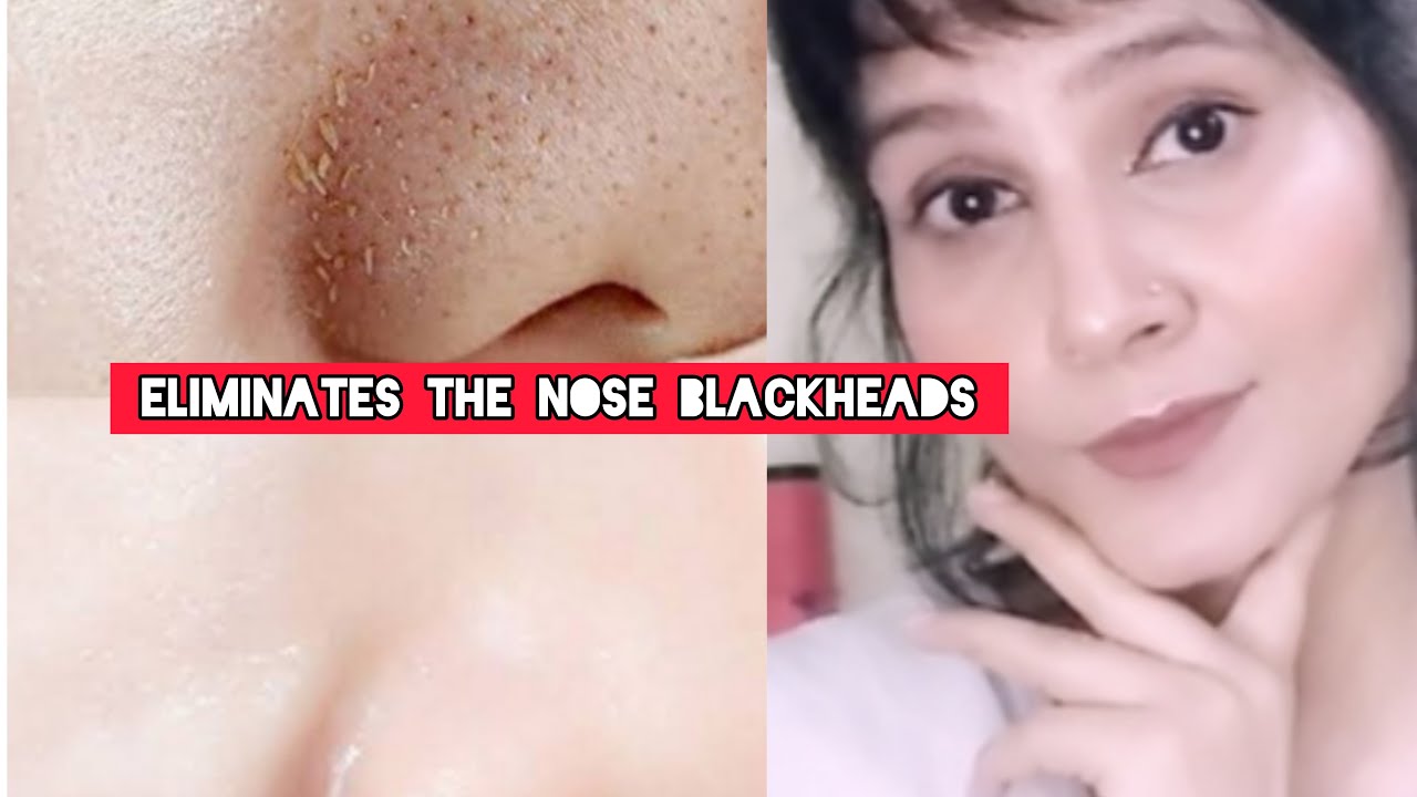 Blackheads and Whiteheads Remove follow in 5 steps and get shiny nose ...