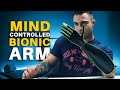 Mind-Controlled Bionic Arm w/iPhone App | How My Prosthetic Arm Works